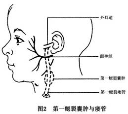 练网球引发腘窝囊肿，如何应对？